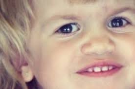 Maroteaux Lamy Syndrome Archives Global Genes