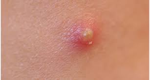 Orang yang aktiv seksual memiliki resiko terkena virus hpv penyebab penyakit kelamin, hampir 70% orang yang aktiv. 8 Petua Merawat Bisul Terutama Di Punggung Ketiak Kepala