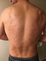 Image result for mite bites on humans