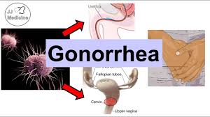 Gonorrhea - Wikipedia