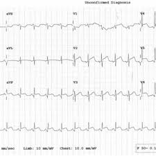Acute pericarditis is a type of pericarditis (inflammation of the sac surrounding the heart, the pericardium) usually lasting less than 6 weeks. Pdf Ecg Spot Diagnosis Acute Pericarditis