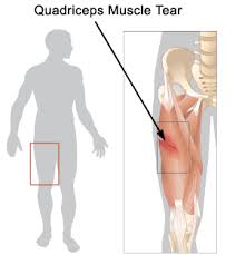 Medical Library Muscle Strain Thigh Exercises Bad Knee Workout