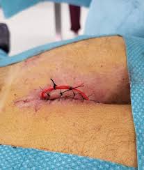 Image result for Pilonidal Cyst