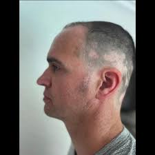 Paul LaGrone shares his story of sudden hair loss and the disease that  caused it