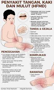 Pada 16 jun 2016, kementerian kesihatan malaysia (kkm) telah mengeluarkan sidang akhbar tentang trend peningkatan kes penyakit tangan kaki dan mulut atau hand, foot and mouth. Tanda Dan Simptom Penyakit Tangan Kaki Dan Mulut Hfmd Blog Informasi