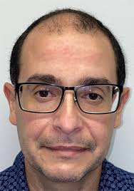 Male Pattern Hair Loss Treatment in Georgia Muscogee Columbus