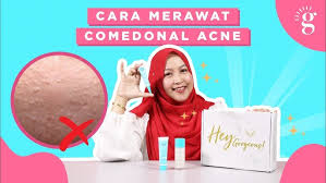 Adakah cara menghindari atau cara menurunkan kolesterol yang ampuh agar terhindar dari bahayanya? Milia Atau Biji Kolesterol Ini 4 Cara Merawat Dan Hilangkan Milia Yang Betul Youtube