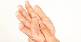 What S The Difference Between Lupus And Ra Rheumatoid Arthritis Rheumatoid Arthritis Diet Arthritis