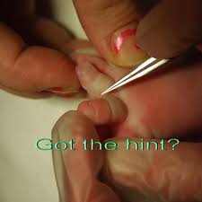 Image result for Elson Extensor Tendon Test