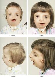 Поиск мутаций в гене tcof1, м. 27 Treacher Collins Syndrome Evaluation And Treatment Pocket Dentistry