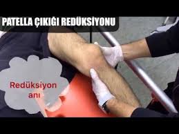 Patella Cikigi Reduksiyonu Youtube