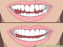 I explain how to close. Can A Retainer Fix A Gap Without Braces