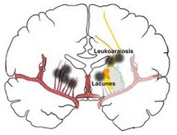 Understand homeopathy treatment for cerebral stroke & the best homeopathic medicine for cerebral stroke, causes, symptoms, treatment, homeopathy medicine, and homeopathic treatment of. Absentmindedness Points To Earlier Warning Signs Of Silent Strokes Among People At Risk Eurekalert Science News