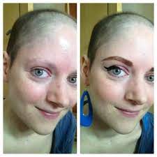 It can be complete, partial, or just thinning, and hair typically does grow back after chemo. Hair Regrowth After Cancer And Why I Ditched The Wigs Breast Cancer Now