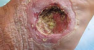 Tita s kitchenette maggots in wounds. Maggot Therapy Wikipedia