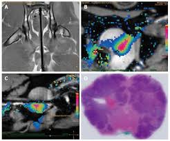 Cavernosal nerve functionality evaluation after magnetic resonance  imaging-guided transurethral ultrasound treatment of the prostate