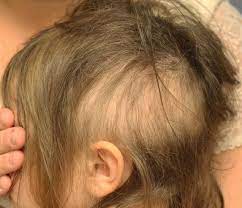 We did not find results for: Visual Diagnosis The Case Of The Balding Preschooler American Academy Of Pediatrics