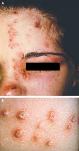Image result for herpes zoster