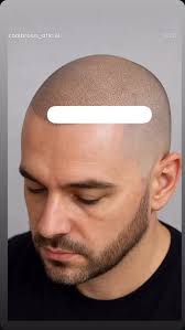 Bring back your confidence with SCALP MICROPIGMENTATION 💉 Instant, natural  & long-lasting results... A quick, effective solution ! NO surgery & NO  complicated maintenance... Choose your look: Natural hairline Modern