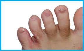 See more of le pousse pied on facebook. Pathologies Frequentes Clinique Podiatrique De Lanaudiere