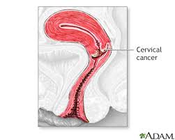 Hpv 16 and hpv 18 are the two highest risk types of the virus and known to cause about 70% of cervical cancer. Cervical Cancer Information Mount Sinai New York