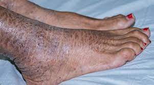 مرض حراشف السمك دليلك الشامل ويب طب