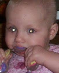 The most common types in children are acute lymphocytic leukemia (all) and acute myeloid leukemia (aml). Retinoblastoma Referral And Diagnosis We C Hope