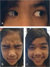 Beyond Gradenigo syndrome: Facial palsy and cavernous sinus involvement in  a young teenage girl