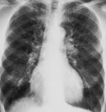Chronic obstructive pulmonary disease (copd) is a serious lung disease that includes a few different breathing conditions. Chronic Obstructive Pulmonary Disease Copd Pulmonary Disorders Msd Manual Professional Edition