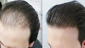 عملية زراعة الشعر الخطوات والتقنيات والنتائج Sac Sac Dokulmesi Hizli Sac Uzama