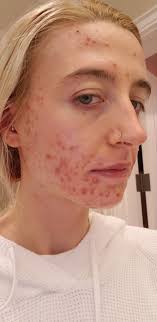 Is it safe to take accutane for dry lips? The Accutane Guide And The Gut Health And Acne Connection Crystal Clear By Karisa