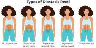 These days, more healthcare providers are realizing how important this assessment is and, while at your appointment, feel free to bring up next steps with your care provider. Diastasis Recti In Pregnancy Postpartum Ab Separation Causes Symptoms Treatment