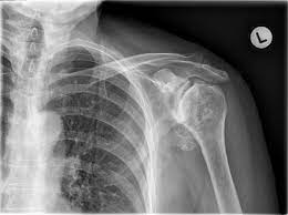 The strap is padded and transfers the weight of the tool to your body, increasing your comfort and reducing fatigue during extended use. Milwaukee Shoulder Radiology Reference Article Radiopaedia Org