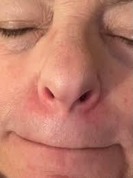 Red nose mask and headgear cleaning tips needed