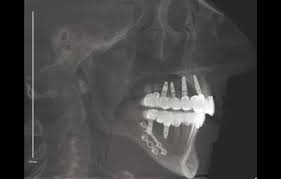 Image result for ochrana chrupu