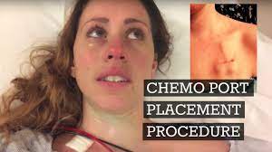 I initially refused chemo, but then learned of my unique diagnosis and aggressiveness of these. Chemo Port Placement Procedure Vlog Youtube