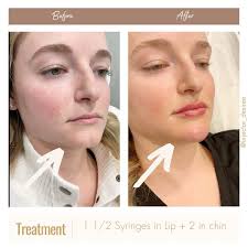 DESIREE MOSER, RN (@injector_desiree) • Instagram फोटोहरू र भिडियोहरू