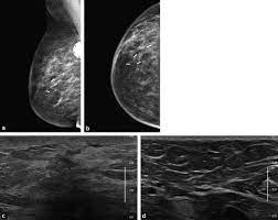 Mammogram imaging may show skin thickening, but often there is no distinct mass found on physical examination or … Imaging Inflammatory Breast Cancer Sciencedirect