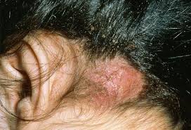 Bed Bug Black Bugs In Hair Not Lice Head Lice Allergies Itching From Lice Is Caused By An Allergic Reaction To Their Bites Scratching May Lead Head Lice Infestation Lice Infestation Head Louse