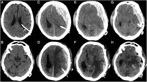 Maybe you would like to learn more about one of these? Imaging Assessment Of Traumatic Brain Injury Postgraduate Medical Journal