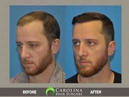 How Much Does A Hair Transplant Cost In Turkey Vs Usa