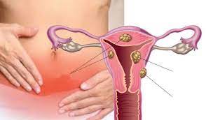 Fibroid pedunkel berbentuk gagang tercetus apabila fibroid subserous mengeluarkan tangkai atau pedunkel, membesar serta membengkok dan menyebabkan kesakitan yang amat sangat. Klinik Avicenna Fibroid Bahaya Ke Banyak Sangat Facebook