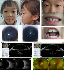 Identification of a novel single nucleotide deletion in the NHS causing  Nance-Horan syndrome