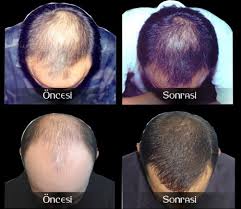 Sac Cikaran Serum Kullanimi Ve Faydalari Serum Gen Tr