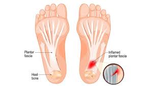 Kali ini saya akan memberikan tips cara mudah melatih kaki kiri. Ini 7 Penyebab Nyeri Tumit Yang Paling Sering Terjadi