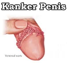 Image result for kanker