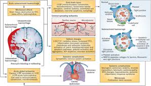 The Critical Care Management Of Poor Grade Subarachnoid Haemorrhage Critical Care Full Text A brain aneurysm is a bulge in an artery within the brain.
