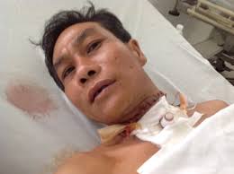 Cấp cứu thành công một người bị đứt lìa khí quản