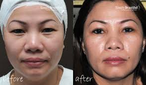 Even the plastic handles on the green older version are thicker and feel like better quality. Upper Eye Lift Surgery
