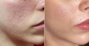 Morpheus8™️ vorher/nachher Die Kombination aus Microneedling &  Radiofrequenz. ⚡️ Sichtbare Entfernung der Aknenarben ⚡️ Verbesserung des  Hautbildes ⚡️ Reduzierung der Falten #morpheus8 #inmode #inmodemorpheus8  #aknenarben #akne #faltenfrei ...